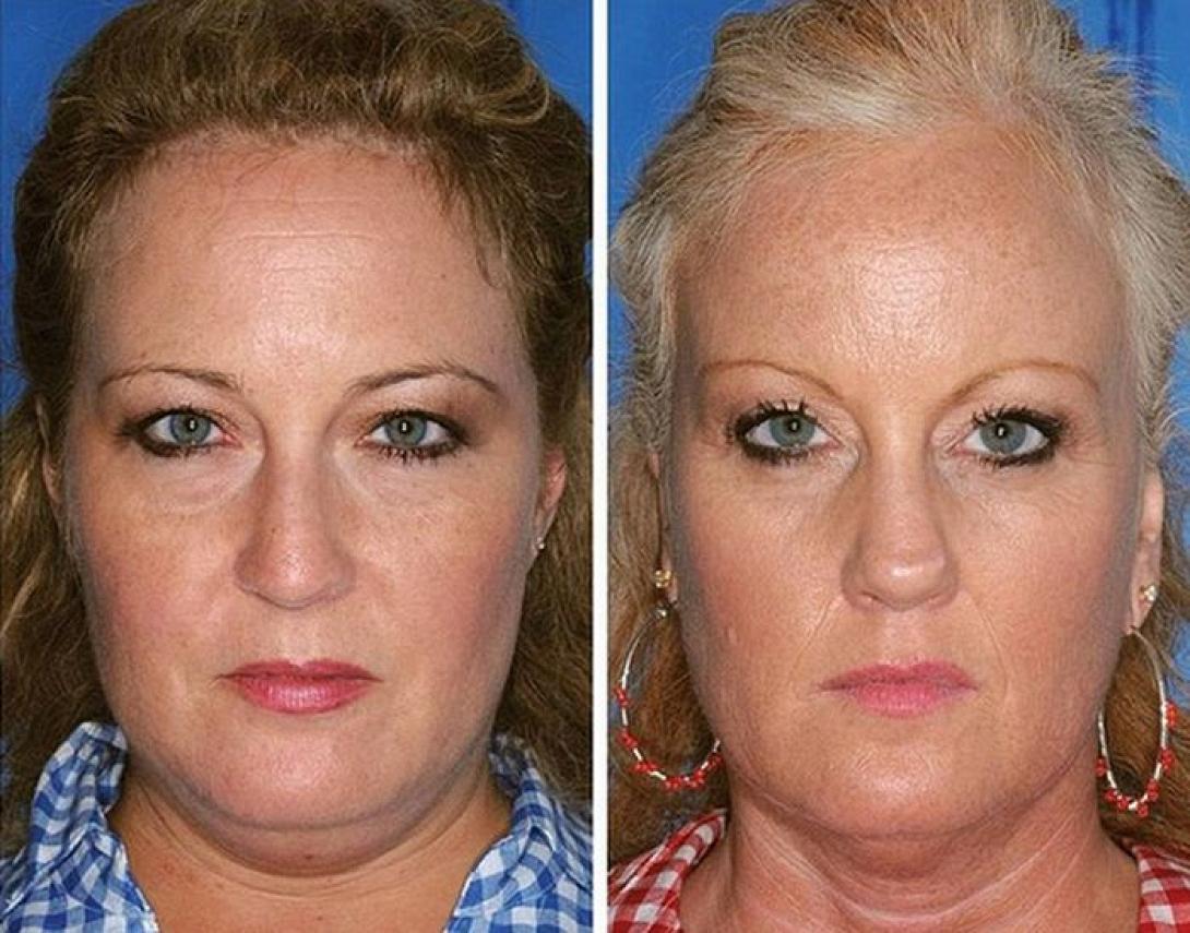 Δίδυμος καπνιστής VS δίδυμος μη-καπνιστής: Κόψτε το κάπνισμα και σώστε το δέρμα σας.