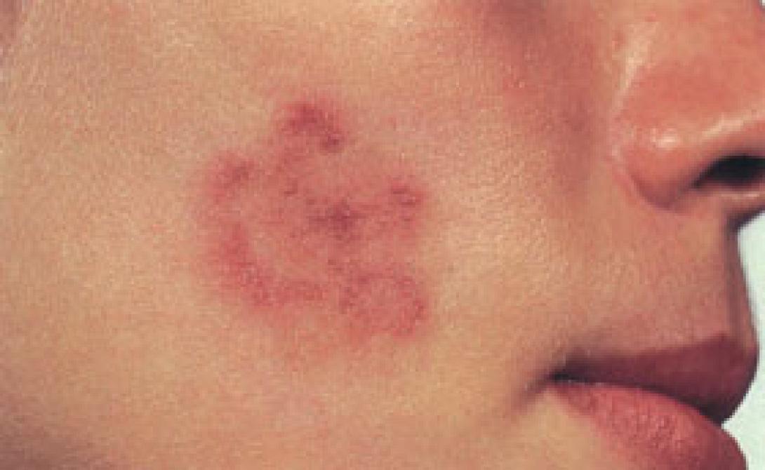 Λιγότερες πιθανότητες για καρκίνο του δέρματος όσοι έχουν έκζεμα