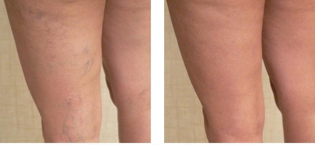 Λάδι για τις ευρυαγγείες 