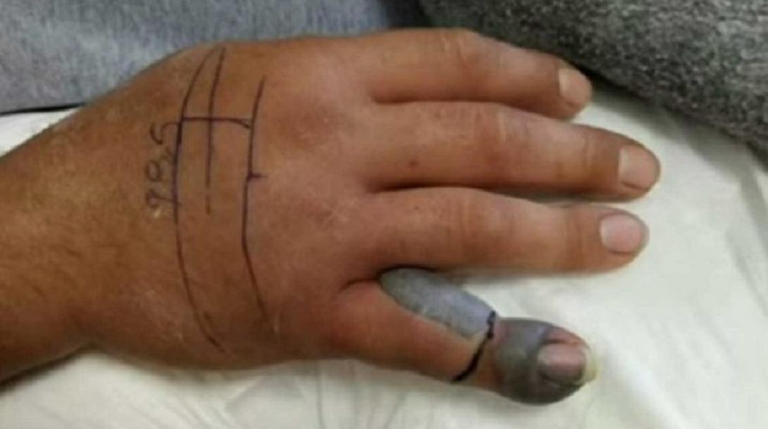 δάγκωμα οχιάς