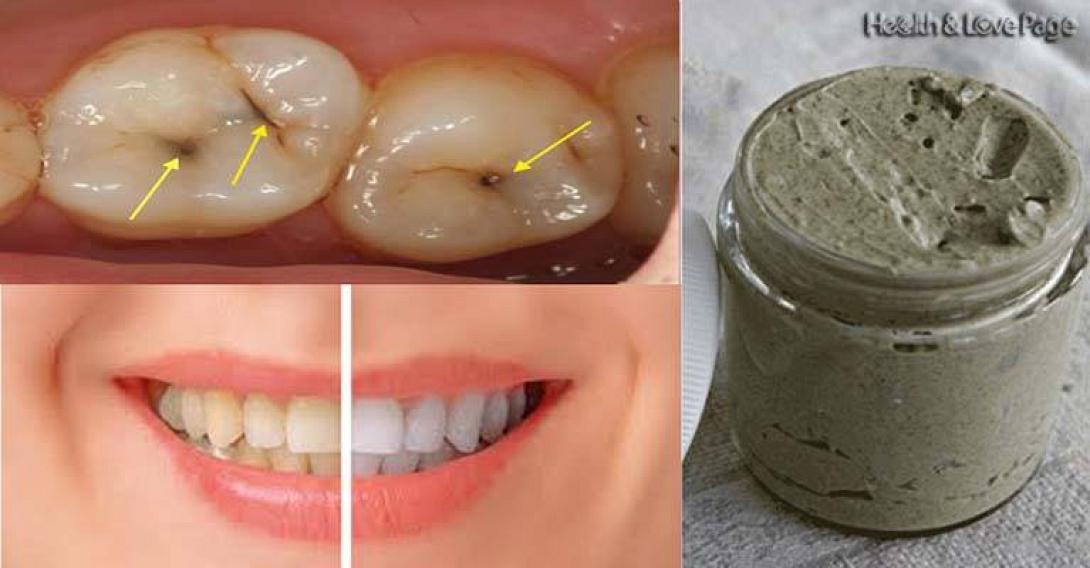 heal-cavities-gum-disease-and-whiten-teeth-with-this-natural-homemade-toothpaste.jpg