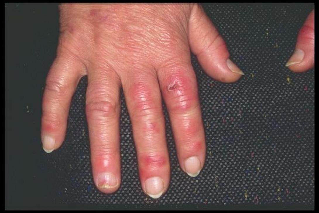 χιονίστρες