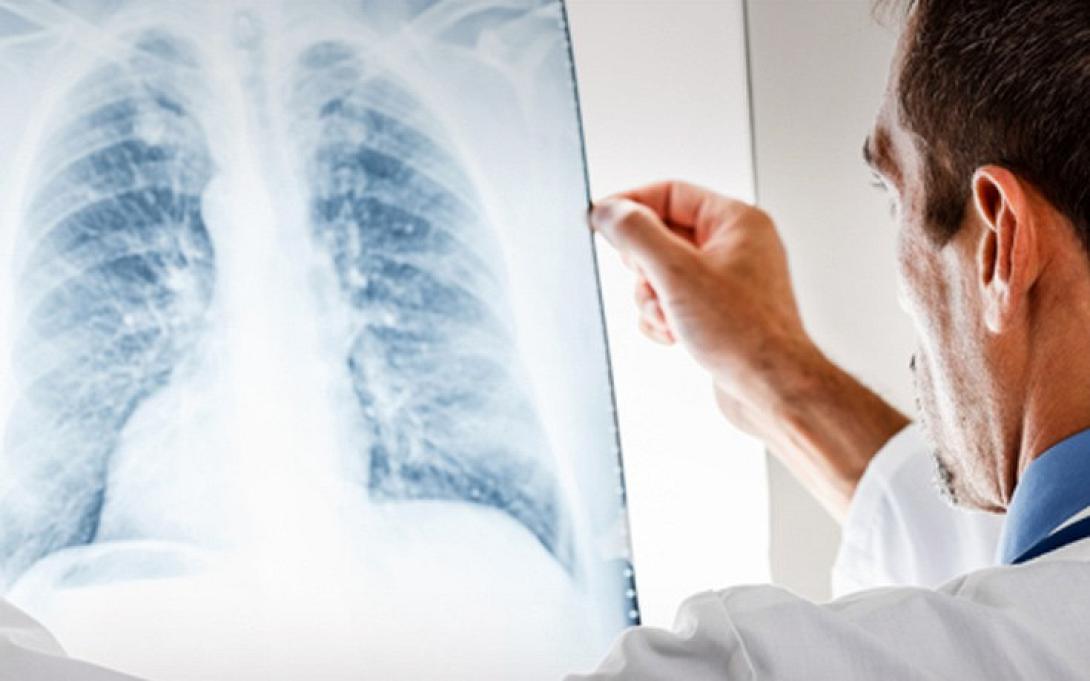 πνευμονικη ινωση