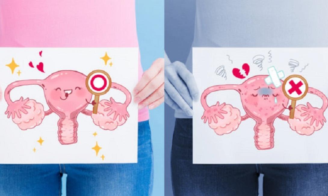 Καρκίνος των ωοθηκών