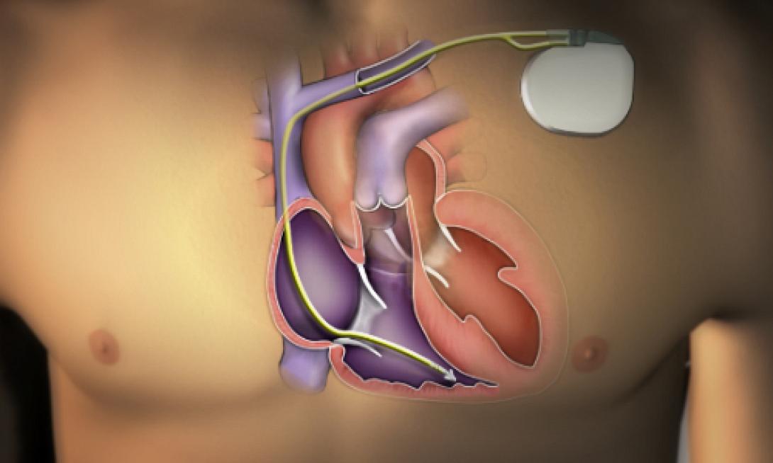 βηματοδότης