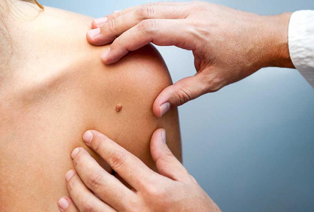 καρκίνος δέρματος