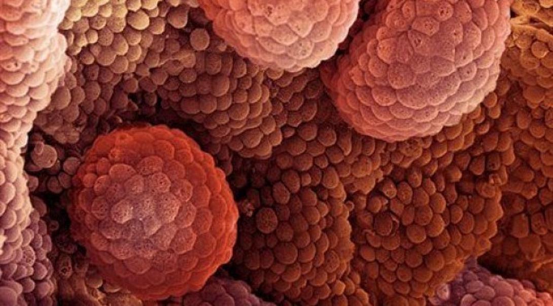 Ο καρκίνος «προτιμά» τέσσερις νομούς της Μακεδονίας