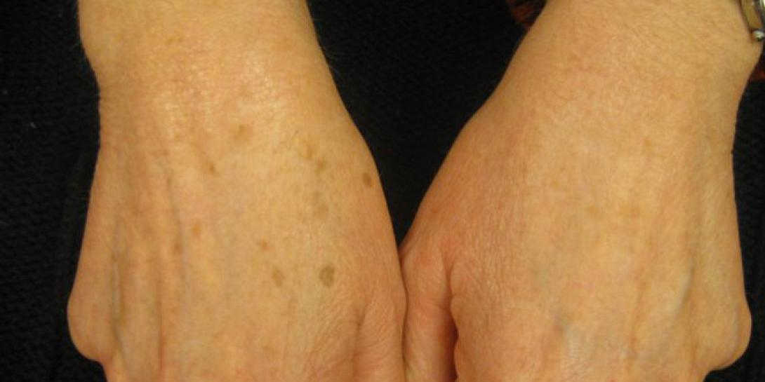 Κηλίδες στα χέρια; Όχι πια!