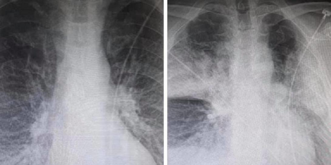 κορωνοϊός - ακτινογραφία