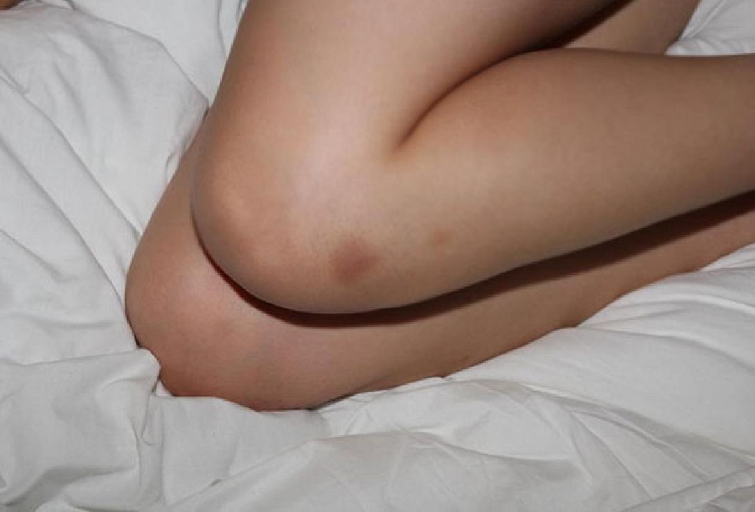 Τελικά οι μελανιές δεν είναι και τόσο αθώες