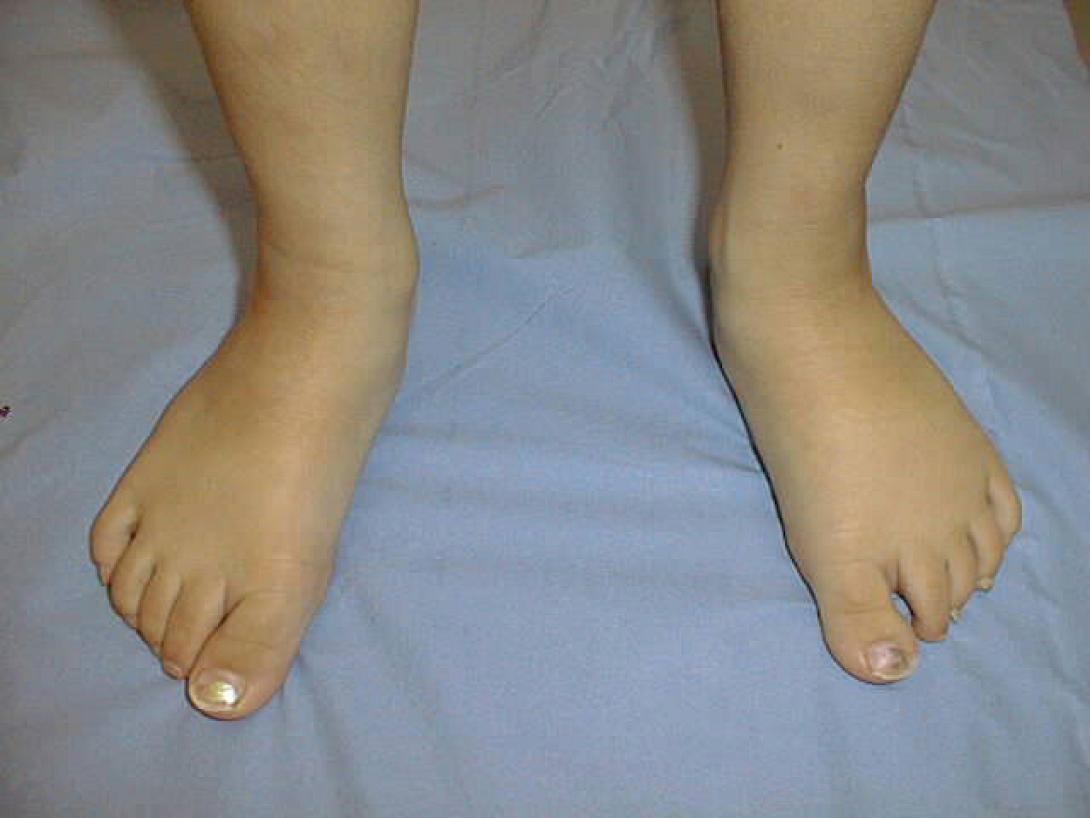 λεμφοίδημα