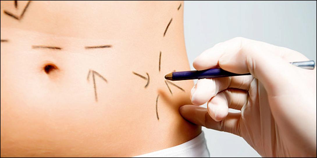 Η "έξυπνη" λιποαναρρόφηση ... κάνει θαύματα