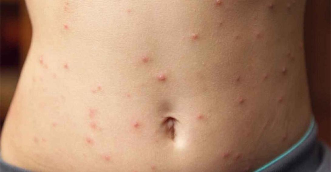 measles-adult.jpg