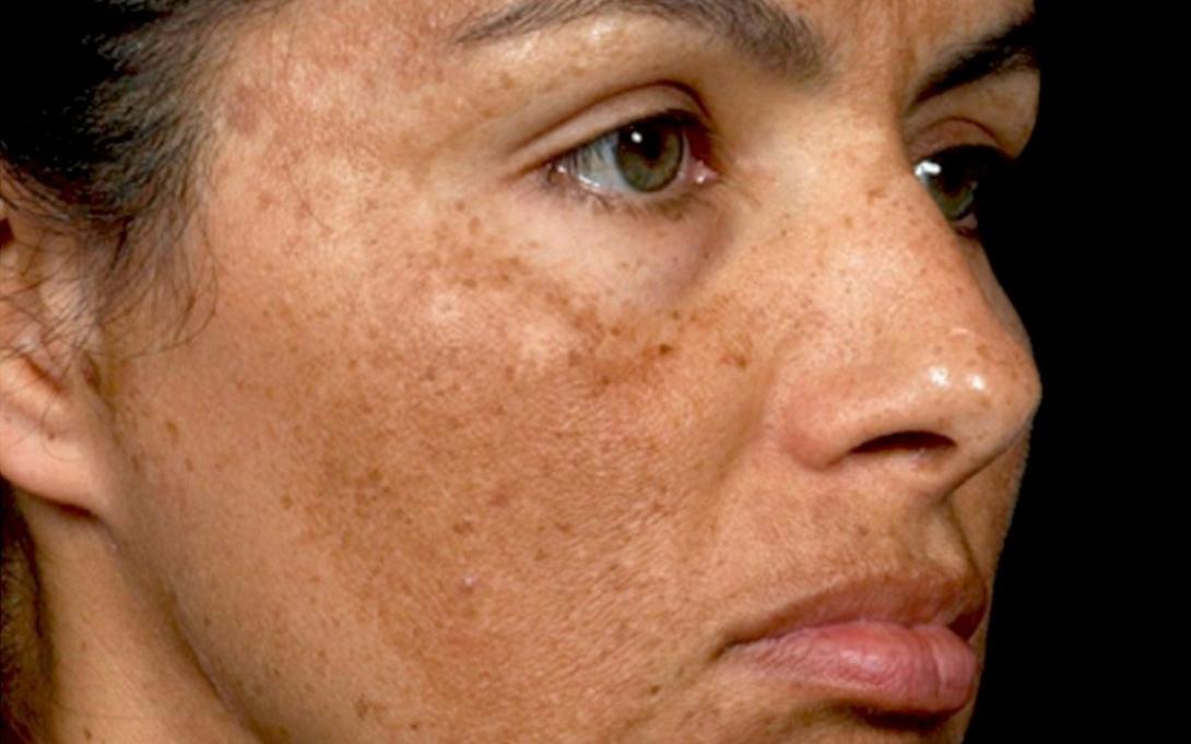 πανάδες φωτογήρανση