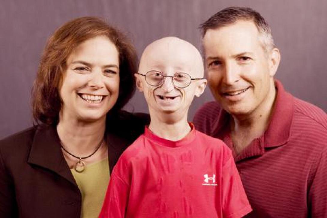 Ο 17χρονος που πέθανε από πρόωρη γήρανση