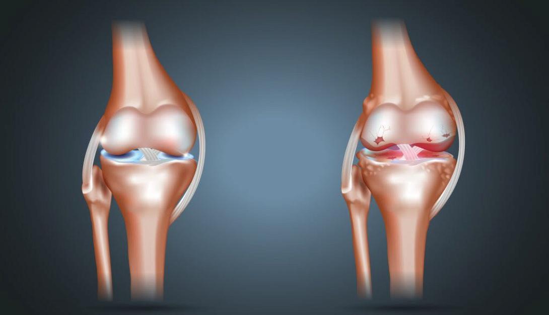 osteoarthritida_.jpg