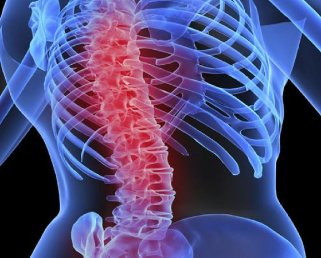 οστεοπόρωση