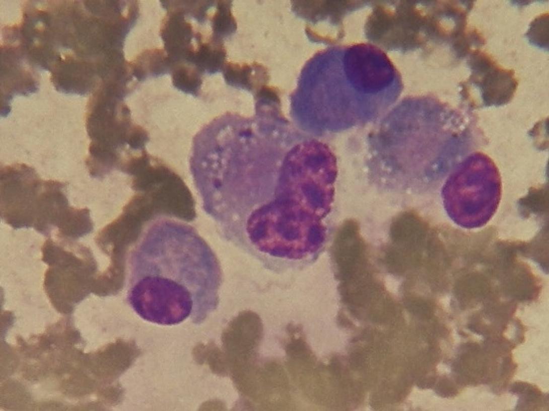 Νέα ανακάλυψη δίνει ελπίδα σε παιδιά που πάσχουν από οστεοσάρκωμα