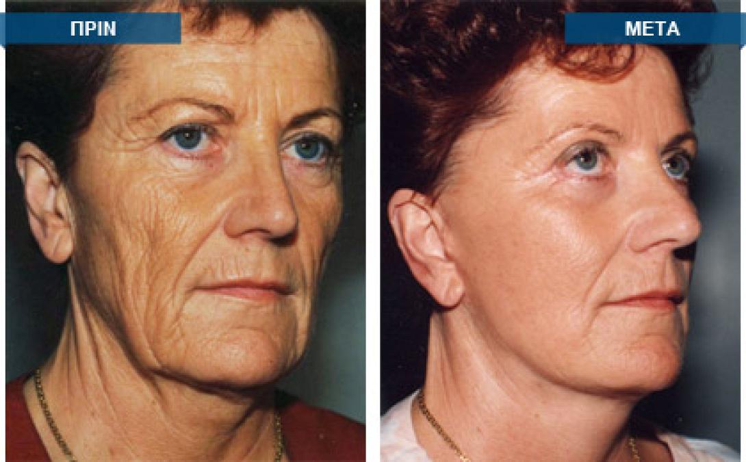 5 Φυσικοί τρόποι για να αποφύγουμε τη χαλάρωση του δέρματος