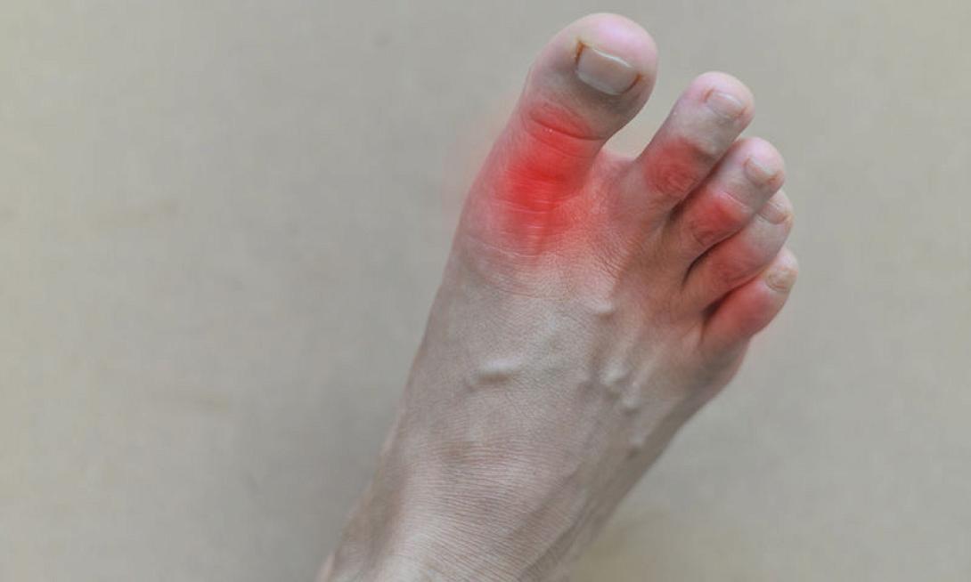 Ουρική Αρθρίτιδα