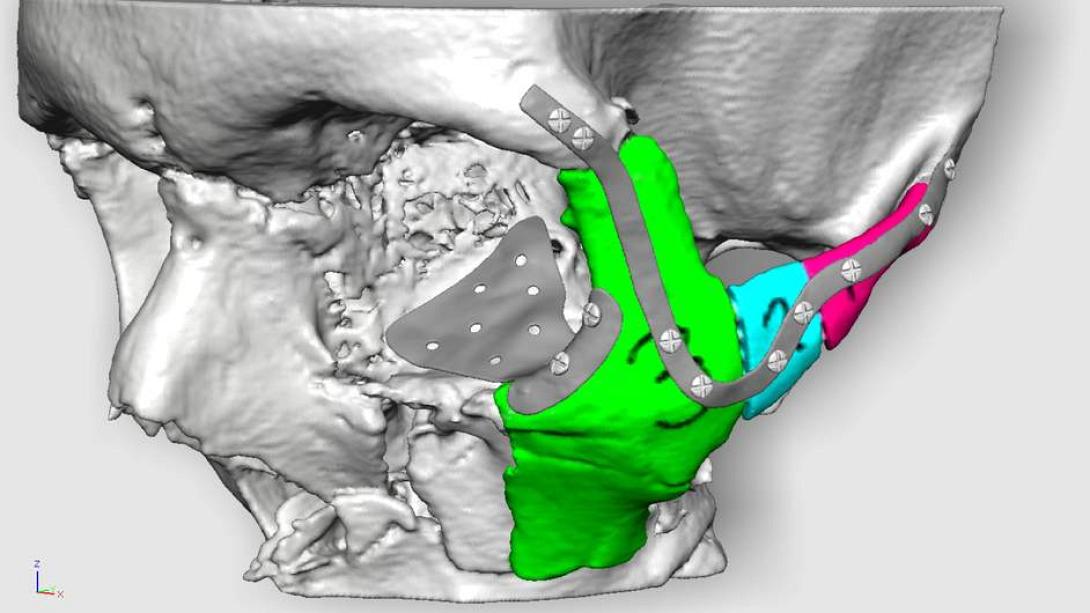 Εκτυπωτής 3D θα αποκαταστήσει πρόσωπο τραυματισμένου άνδρα.