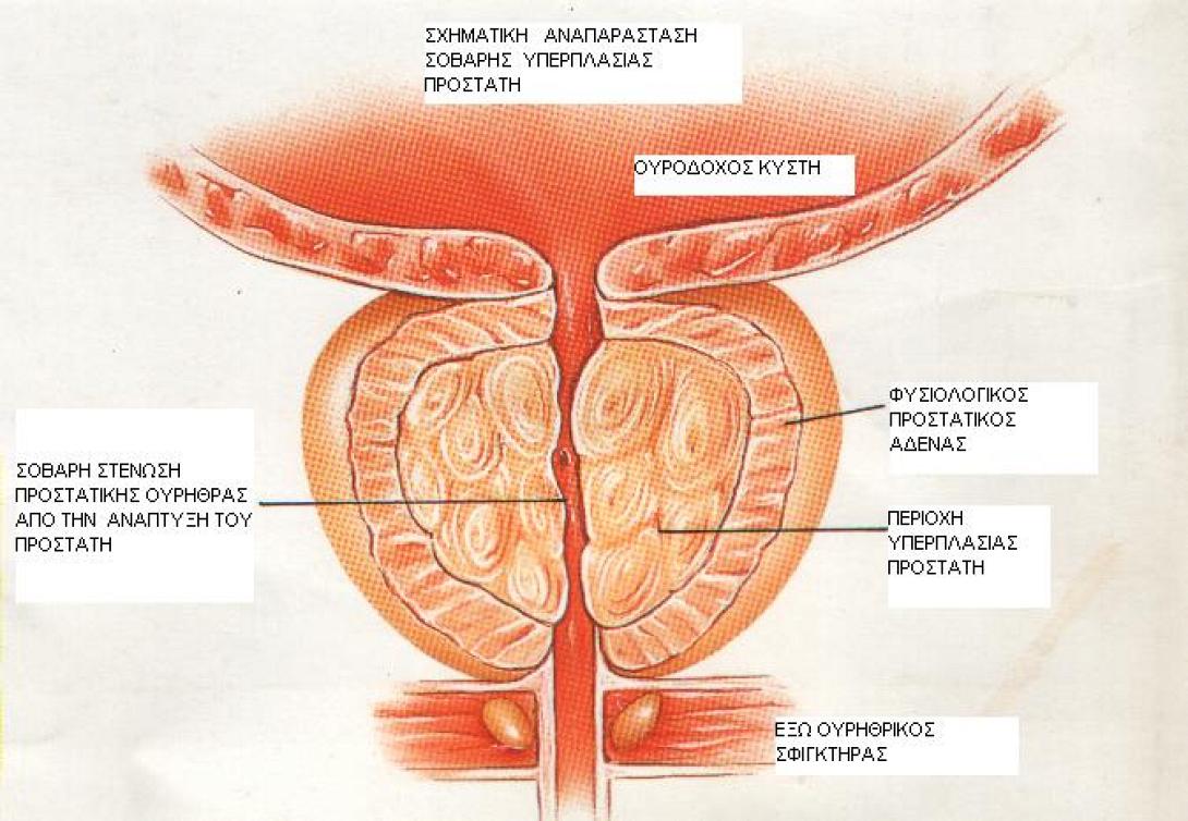 προστάτης
