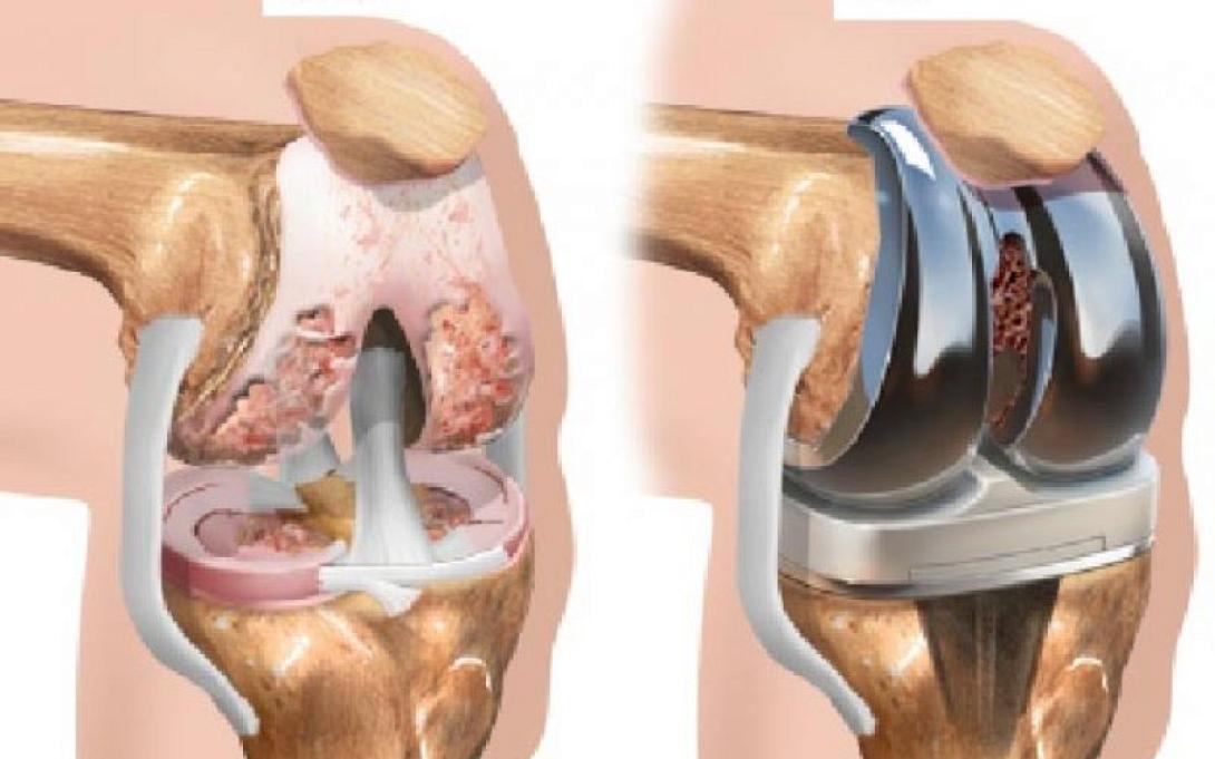αρθροπλαστική