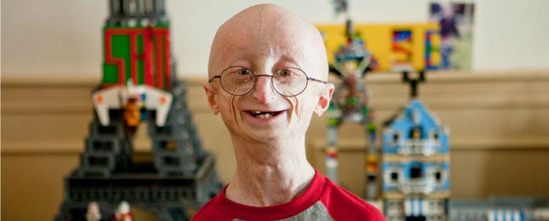 "Έφυγε " ο 17χρονος που έπασχε από πρόωρη γήρανση