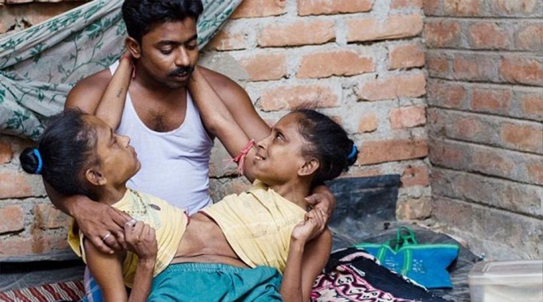 Σιαμαίες για 45 ολόκληρα χρόνια (βίντεο)