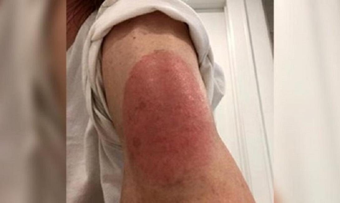 Δερματικό εξάνθημα σε ορισμένους ασθενείς που έχουν λάβει το εμβόλιο Moderna mRNA-1273