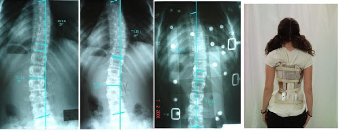 Επιστημονική εκδήλωση στο ΠΑΓΝΗ για τις παραμορφώσεις της Σπονδυλικής Στήλης