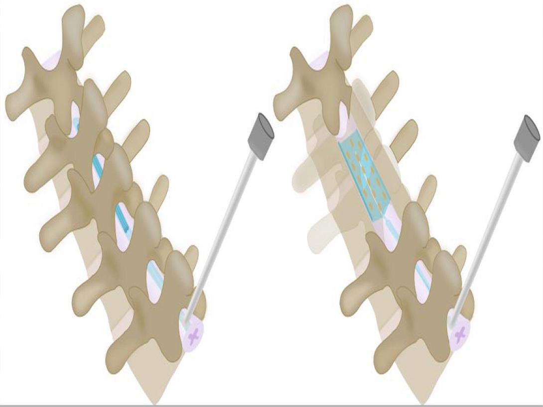 σπονδυλική στήλη εμφύτευμα