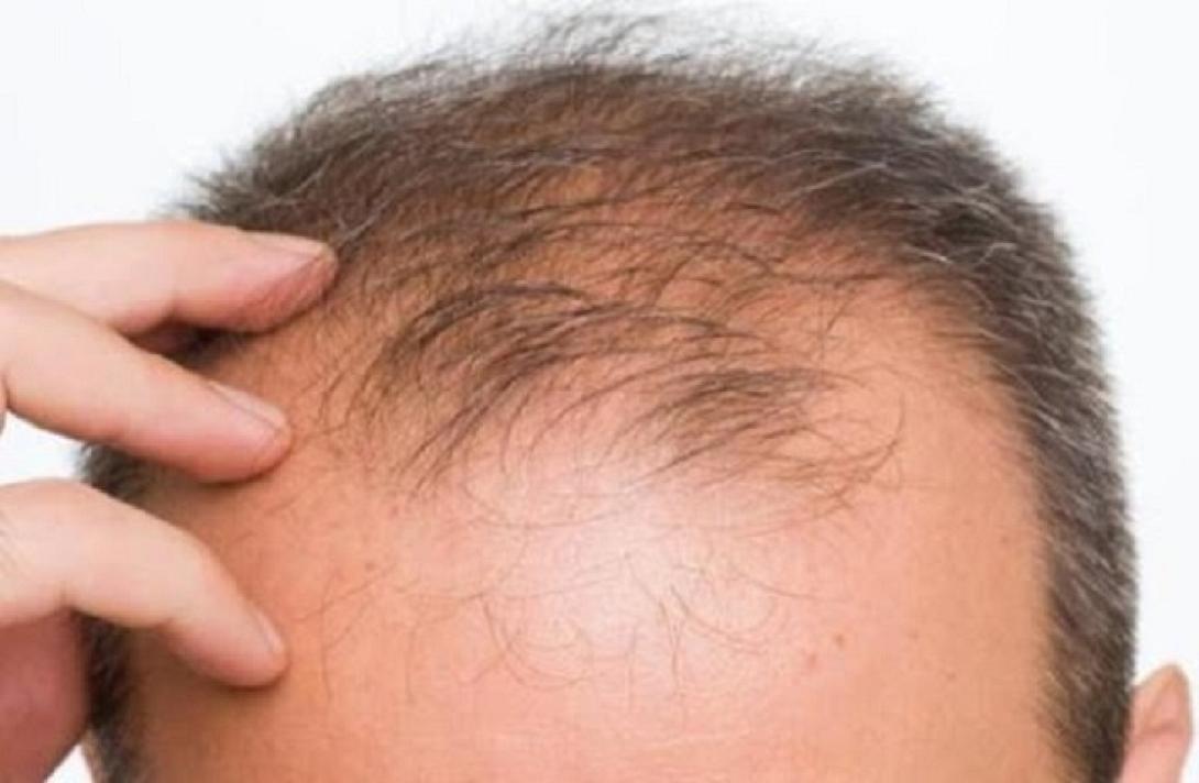 απώλεια μαλλιων