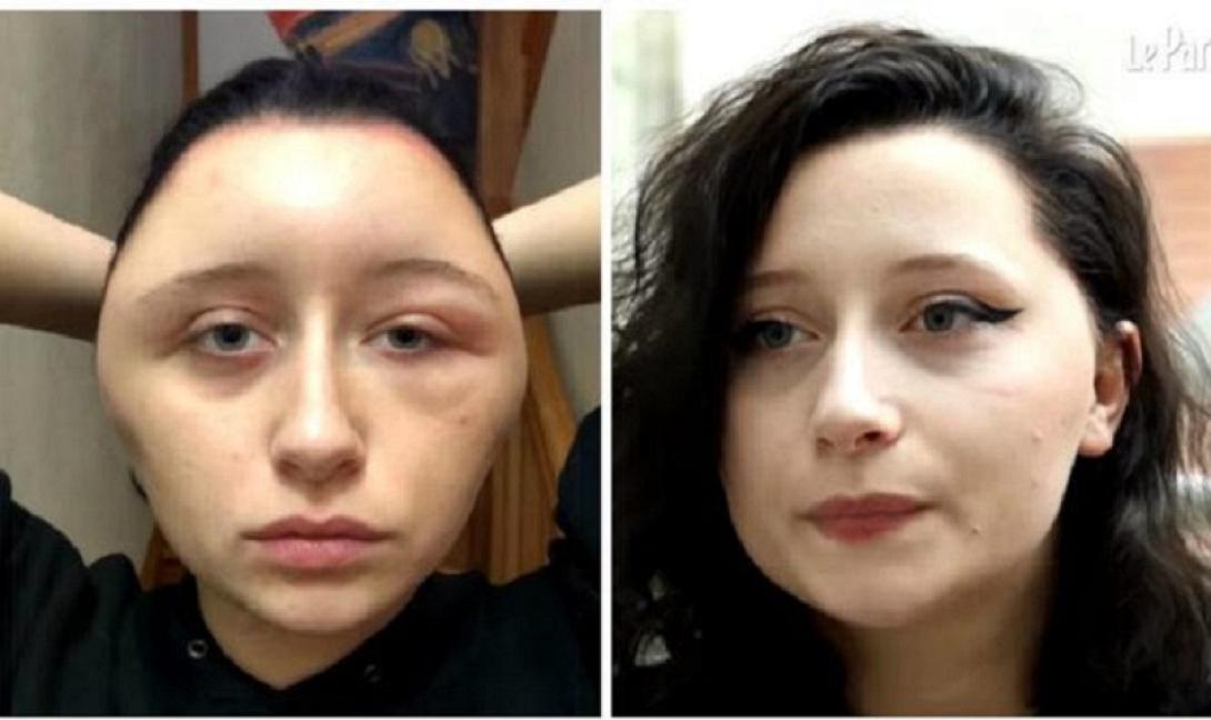 Έπαθε αλλεργία από βαφή μαλλιών 