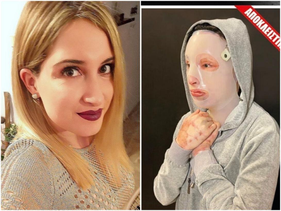 ιωαννα - επιθεση με βιτριολι