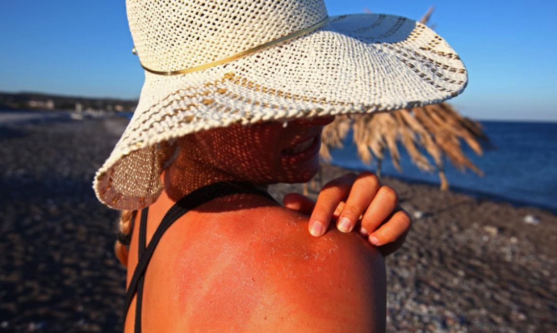 ηλιοθεραπεία εγκαύματα